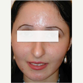 Blue Light Acne Phototherapy (iClearXL, Curelight Medical). after 1561699