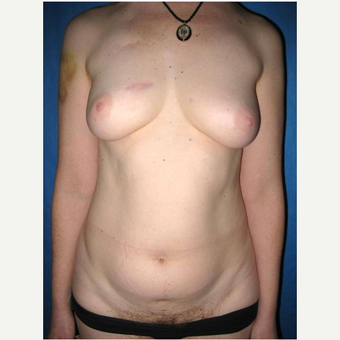 44 year old woman treated with DIEP flap Breast Reconstruction before 3725059