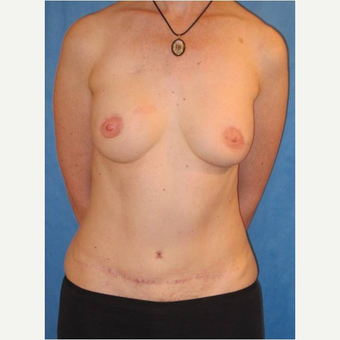 44 year old woman treated with DIEP flap Breast Reconstruction after 3725059