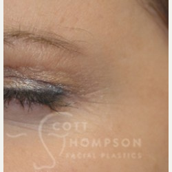 35-44 year old woman treated with Botox after 3456307