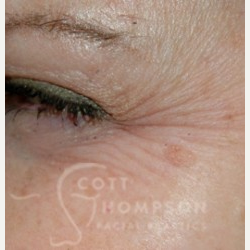 35-44 year old woman treated with Botox before 3456307