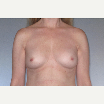 45-54 year old woman treated with Breast Augmentation before 3508536