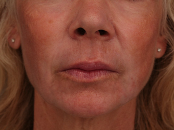 55-64 year old woman treated with CO2 Laser after 3705968