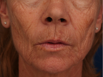 55-64 year old woman treated with CO2 Laser before 3705968