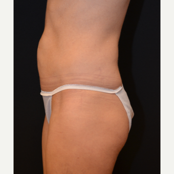 45-54 year old woman treated with Liposuction after 3000347