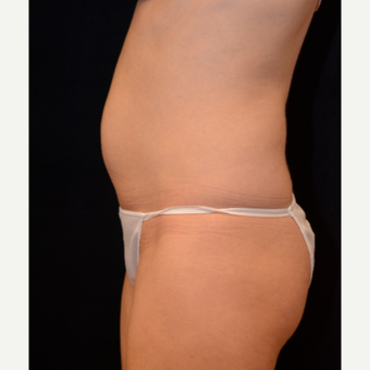 45-54 year old woman treated with Liposuction before 3000347