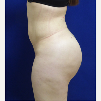 27 y/o female - 1500cc per side Lipo abdomen, flanks, back with fat transfer to the buttocks after 3433762