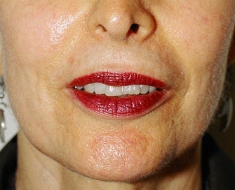 Laser Treatment of Lip Creases-Lip Wrinkles after 1174496