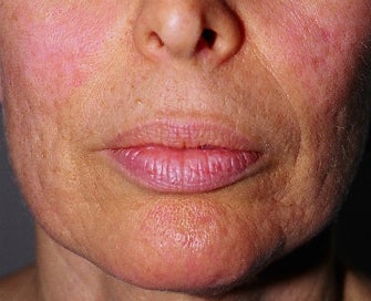 Laser Treatment of Lip Creases-Lip Wrinkles before 1174496