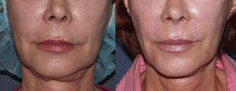 Ulthera Smile Lines | Before and After before 1033979