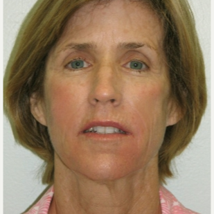 55-64 year old woman treated with Bellafill after 3237123