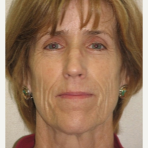 55-64 year old woman treated with Bellafill before 3237123
