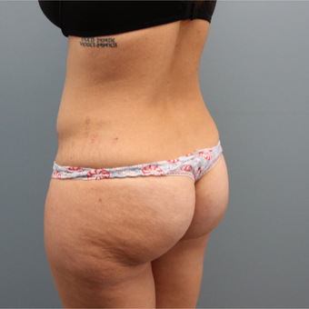 33 year old woman had Butt Augmentation to add volume and improve shape before 3467358