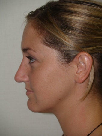 Rhinoplasty after 214750