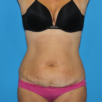 35-44 year old woman treated with Tummy Tuck before 3332922