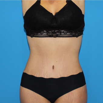 35-44 year old woman treated with Tummy Tuck after 3332922