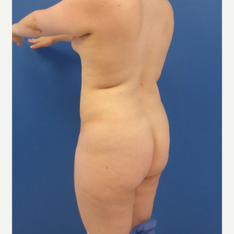 27 y/o female - 1500cc per side Lipo abdomen, flanks, back with fat transfer to the buttocks before 3433769