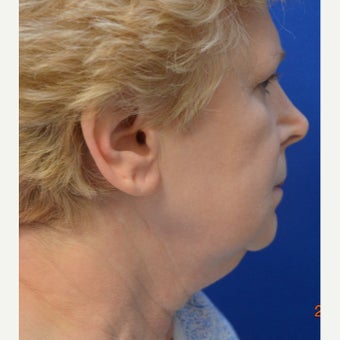 55-64 year old woman treated with ThermiTight before 1747795