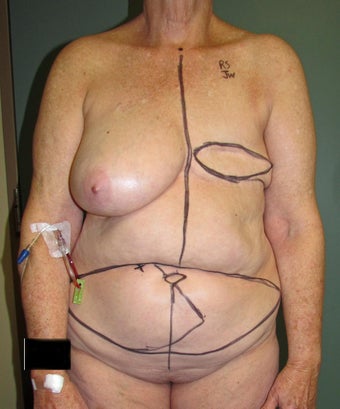 DIEP Flap performed in Nashville, TN before 1116238