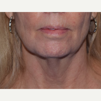 55-64 year old woman treated with laser-assisted Neck Lift before 3638972