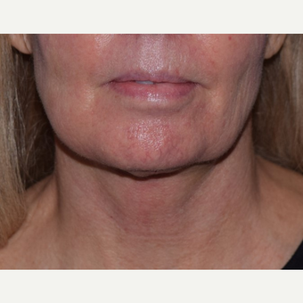 55-64 year old woman treated with laser-assisted Neck Lift after 3638972