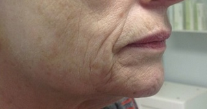 65-74 year old woman treated with Pelleve before 2112724