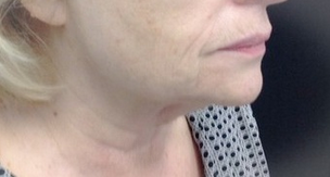 65-74 year old woman treated with Pelleve after 2112724