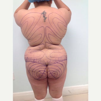 25-34 year old BMI 36 woman treated with Brazilian Butt Lift before 1922508