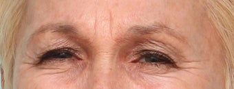 Glabellar Lines - 63 year old female before 965174