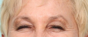 Glabellar Lines - 63 year old female after 965174