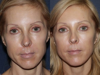 Before & After Fraxel before 806249