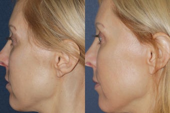 Before & After Fraxel 806249
