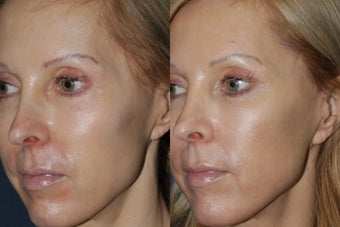 Before & After Fraxel after 806249