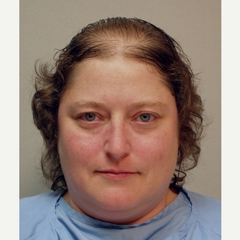 Hair Transplant before 3241456