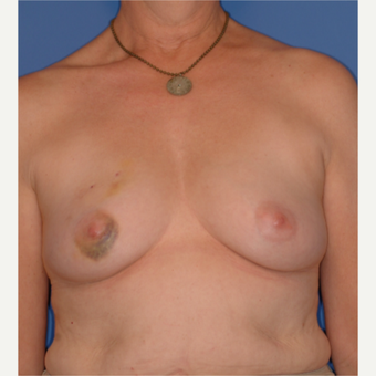 45-54 year old woman treated with Breast Reconstruction before 3619238