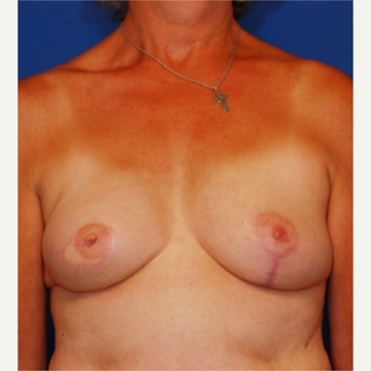 45-54 year old woman treated with Breast Reconstruction after 3619238