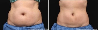 CoolSculpting to Abdomen and Love Handles before 1030577
