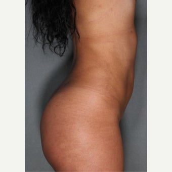 24 year old woman treated with Fat Transfer to Buttocks, SmartLipo to Abdomen & Love Handles after 1811406