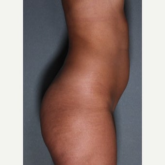 24 year old woman treated with Fat Transfer to Buttocks, SmartLipo to Abdomen & Love Handles before 1811406