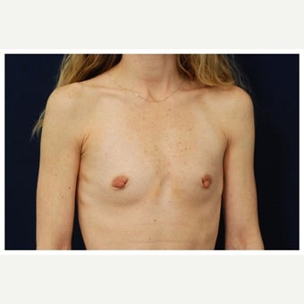 25-34 year old woman treated with Inspira Breast Implants before 1860179