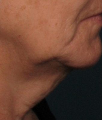 Ultherapy after 460627