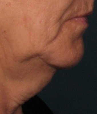 Ultherapy before 460627