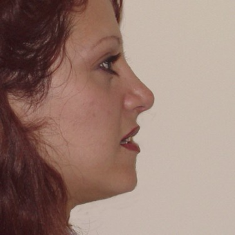 35-44 year old woman treated with Rhinoplasty after 3506409