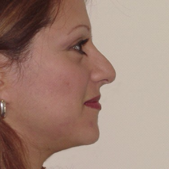 35-44 year old woman treated with Rhinoplasty before 3506409