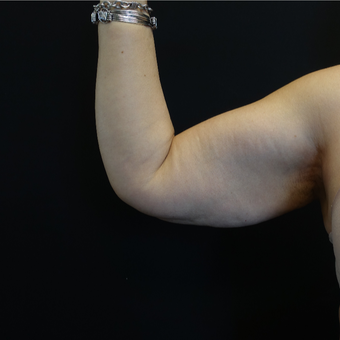 45-54 year old woman treated with Arm Lift before 3730397
