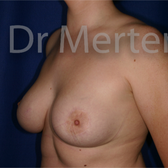 Tuberous breast/asymmetry treated with right breast reduction and left breast lift with implants after 3595390