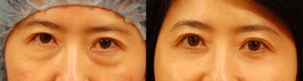 Lower eyelid surgery before 534605