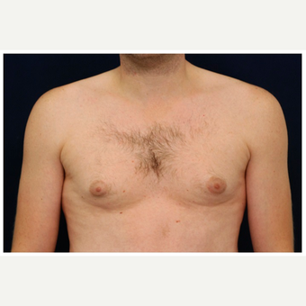 25-34 year old man treated with Male Breast Reduction before 3536854
