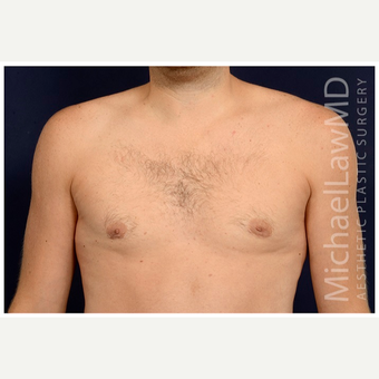 25-34 year old man treated with Male Breast Reduction after 3536854