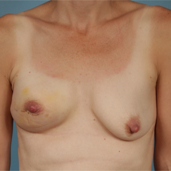 45-54 year old woman treated with Breast Reconstruction before 3730015